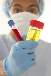 Young man doctor  holding a urine and blood sample for urinary tract infection diagnosis